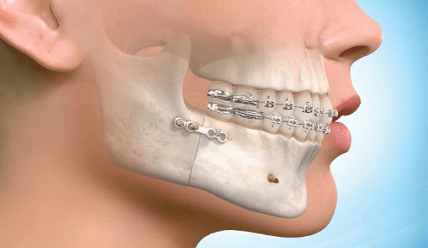 What is the role of Invisalign in dental treatment?