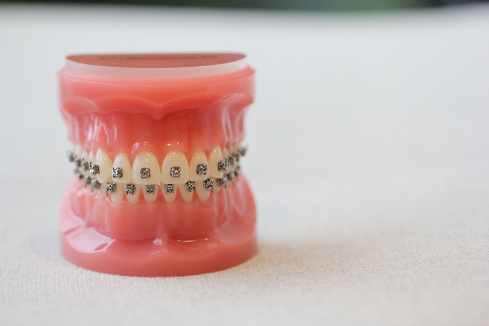 Perfecting Smiles: Invisalign in Redmond and the Art of Kirkland Braces