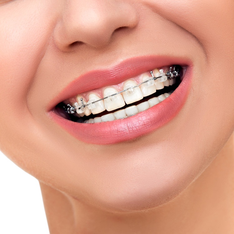 Achieve Your Dream Smile with Mack Orthodontics: Cincinnati's Premier Invisalign Experts