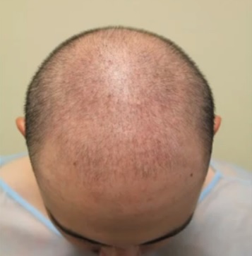 The Future of Hair Restoration: FUE Advancements