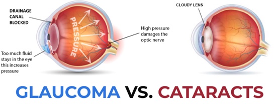 What are the differences between cataract treatment and glaucoma treatment?