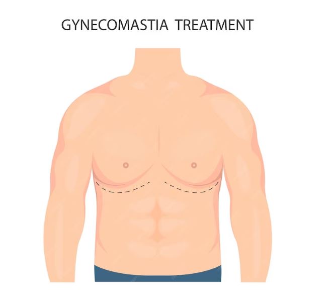 Understanding Gynecomastia: Causes and Plastic Surgery Solutions in Ahmedabad