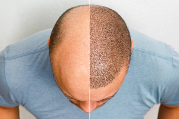 Follicle Frontier: A Deep Dive into the World of Hair Transplant Procedures