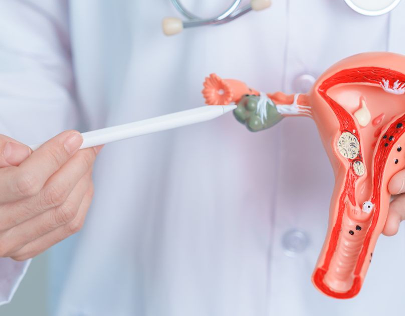 Understanding and Managing Uterine Fibroids