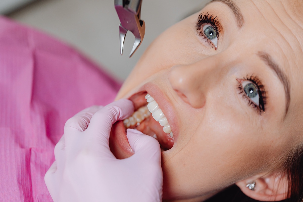Everything You Need to Know About Wisdom Teeth Extraction in Montreal