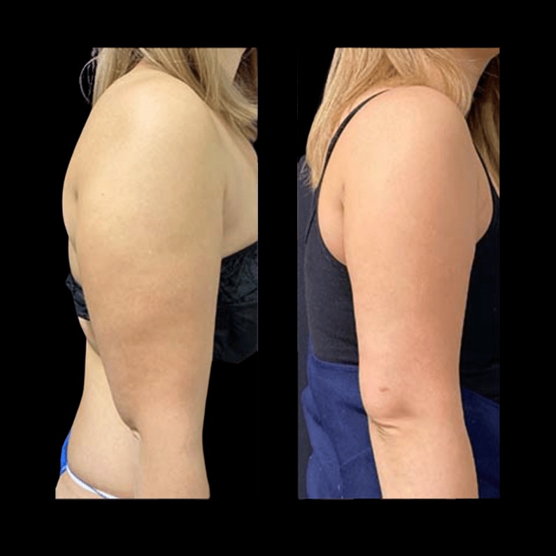 Consultation and Preparing for Arm Liposuction: What to Expect