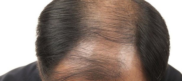 Hair Transplant Treatment for Women: A Comprehensive Guide