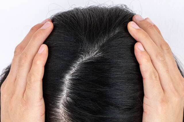 Benefits of Hair Transplants for Receding Hairlines