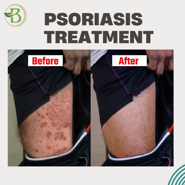Scalp psoriasis homeopathy treatment without any side effect