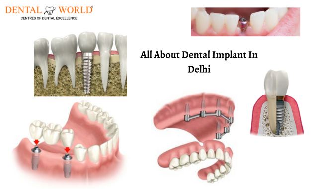 Why Choose Dental Implants in Delhi?