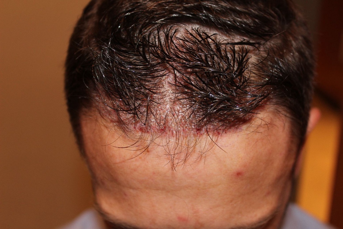 At what age is it appropriate to get a hair transplant?