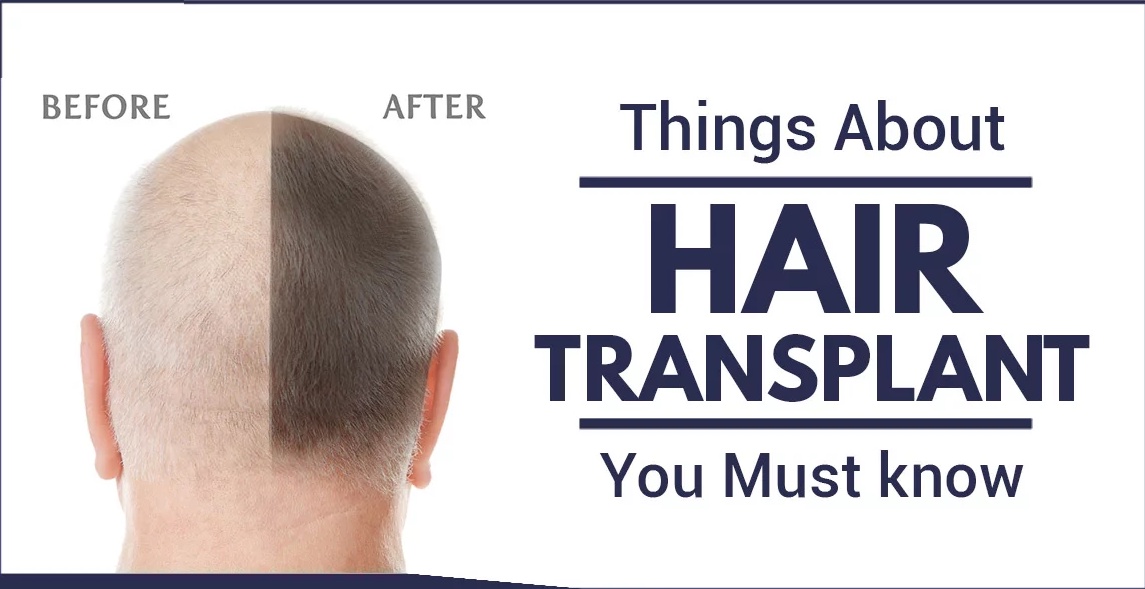 A Dermatological Or Plastic Surgeon Will Transplant Hair To A Bald Area Of The Head During A Hair Transplant
