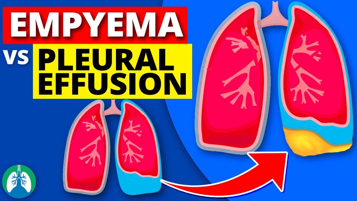 Empyema vs Pleural Effusion: Differentiating between the two conditions