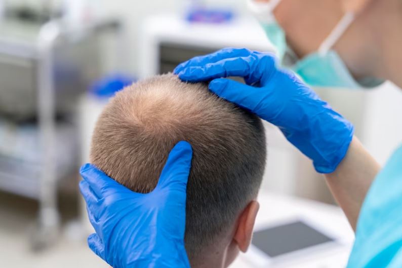 Unlocking Secrets of 2000 Grafts Hair Transplant Cost: Your Guide to Lowest Price Estimate