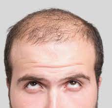 What is the role of scalp laxity in the success of a hair transplant?