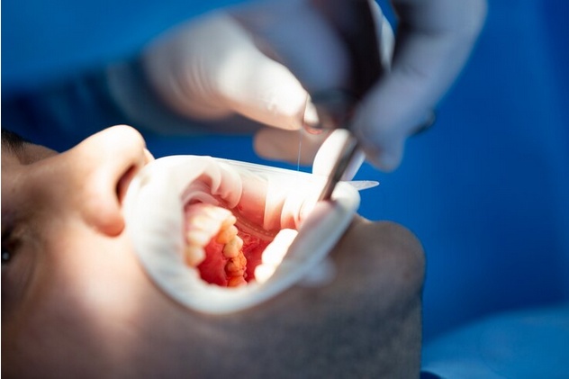 Wisdom Unveiled: A Comprehensive Guide to Wisdom Tooth Extraction in Markham