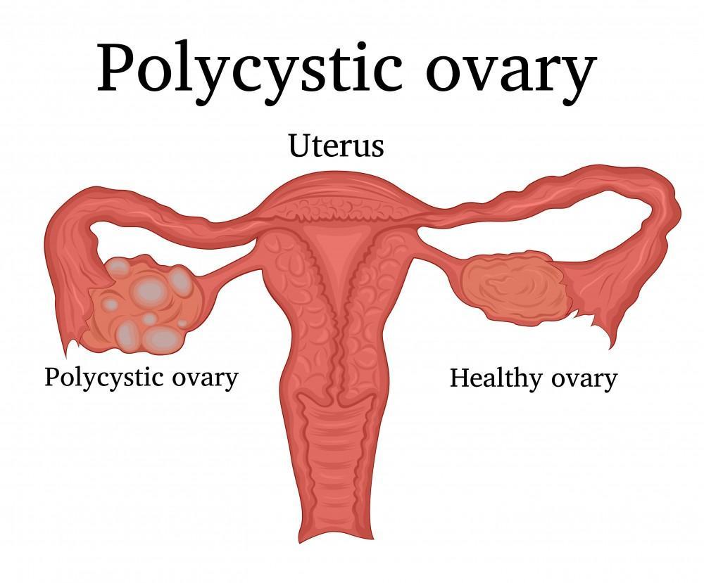 "Unlocking Wellness: Navigating the Challenges of Polycystic Ovarian Syndrome"