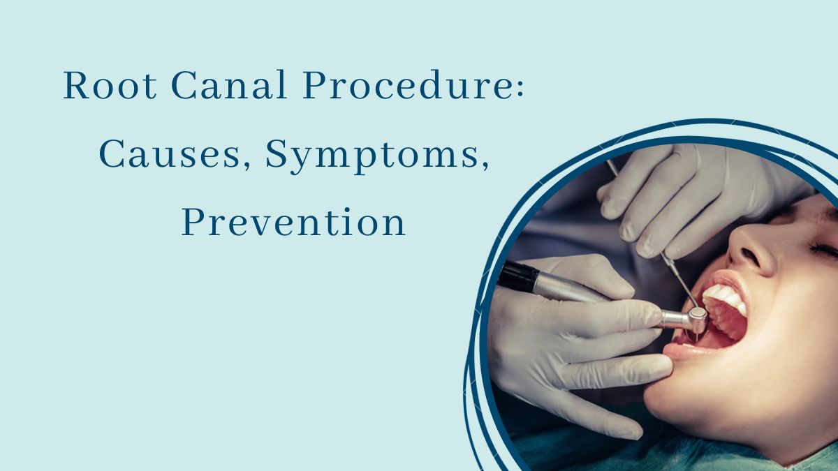 Root Canal Procedure: Causes, Symptoms, Prevention