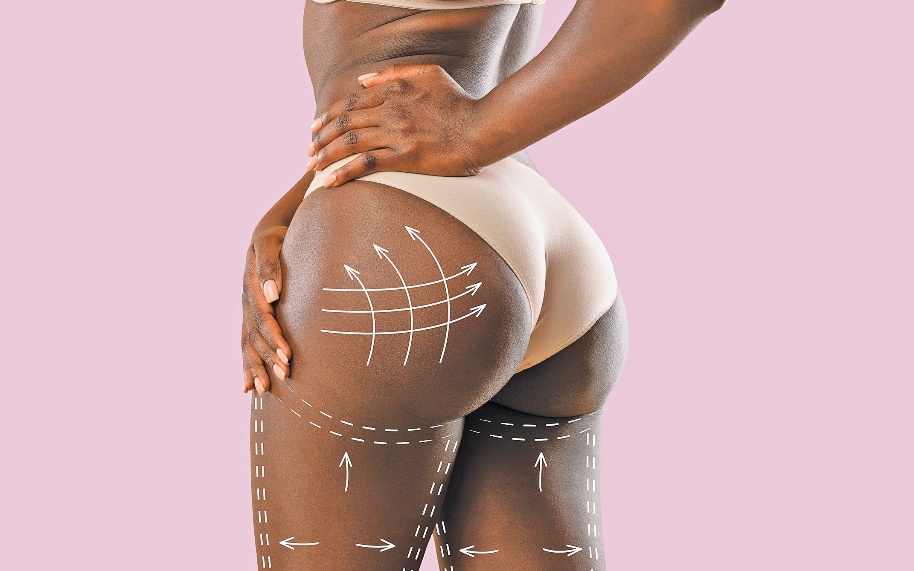 Brazilian Butt Lift: What Is It and How Long the Result Will Last