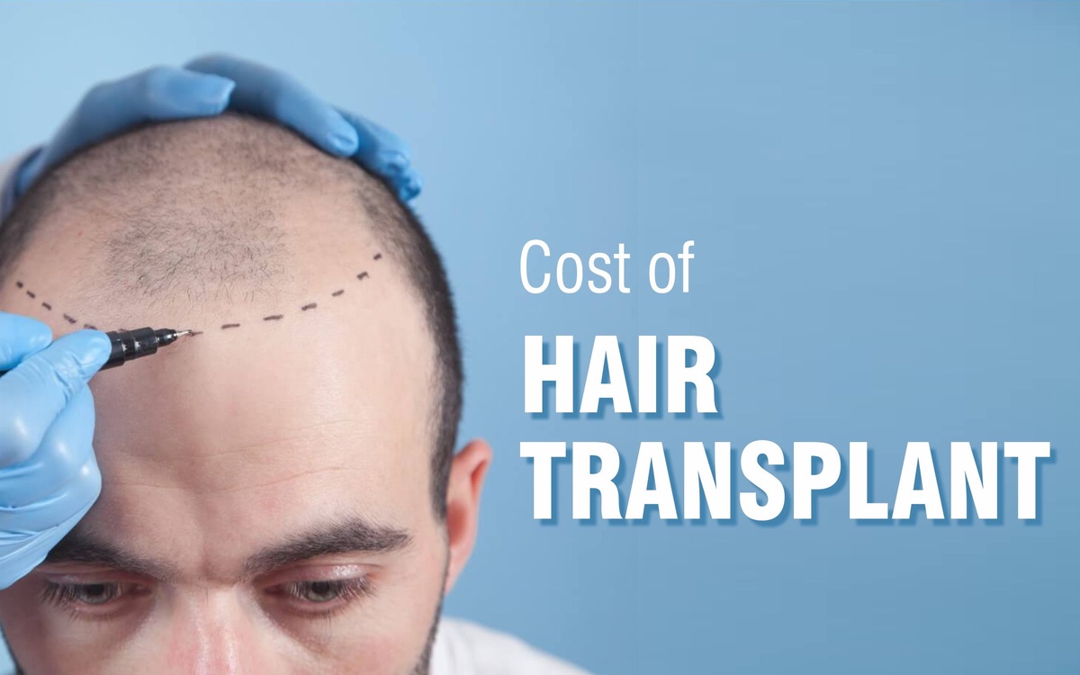 Hair Transplant Prices: How Are They Determined?