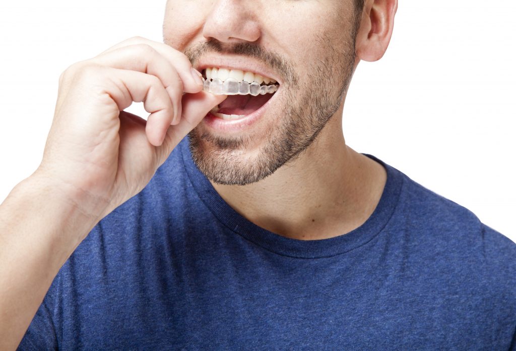 9 Invisalign Best Tips You Need to Know