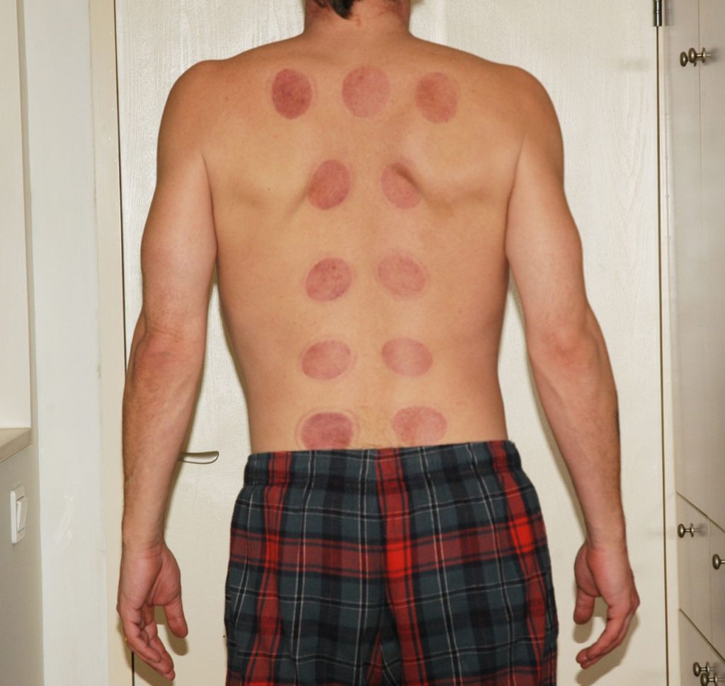 Unlocking the Healing Powers of Cupping Massage: A Path to Wellness
