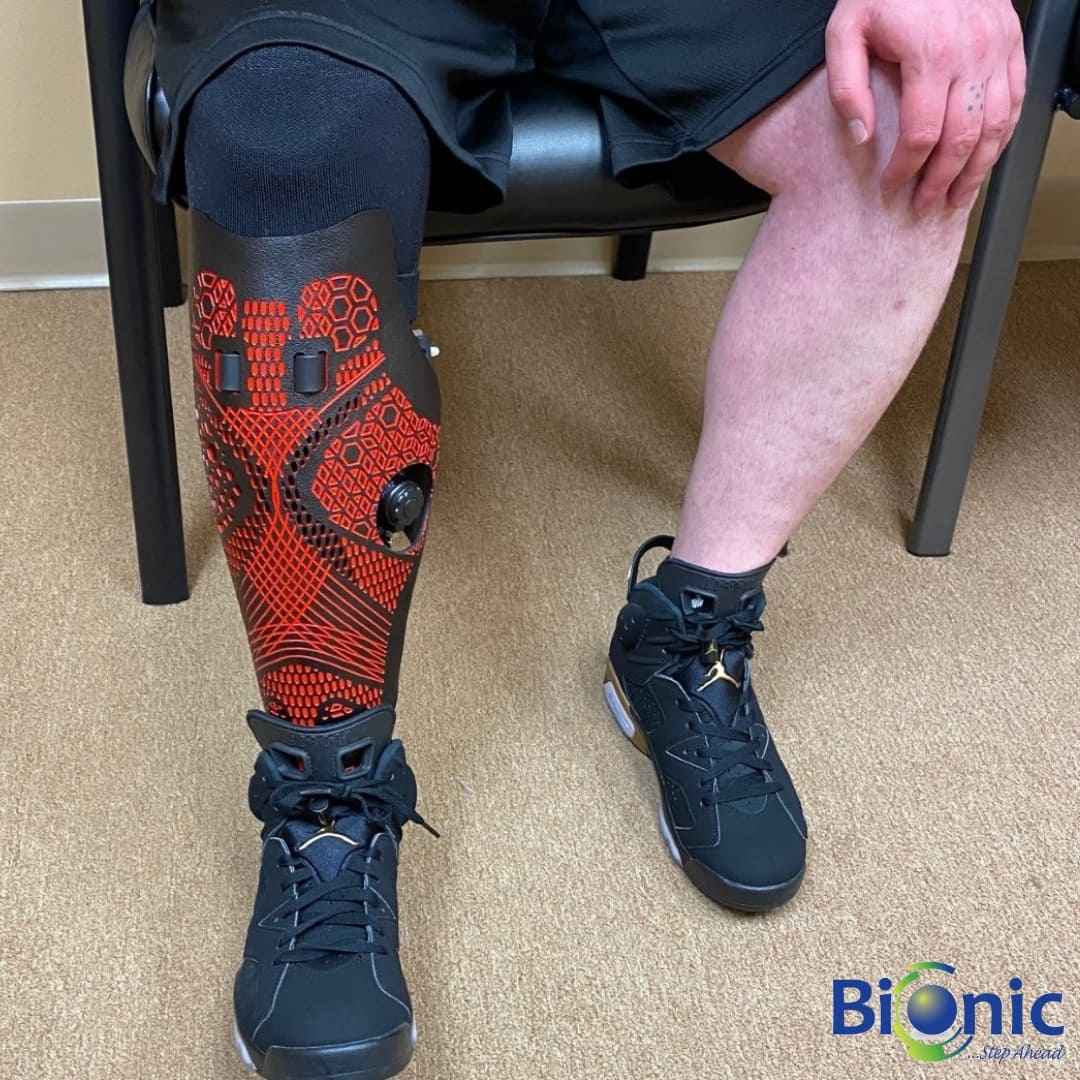 Regaining Mobility and Confidence: Below the Knee Prosthetics by Bionic India