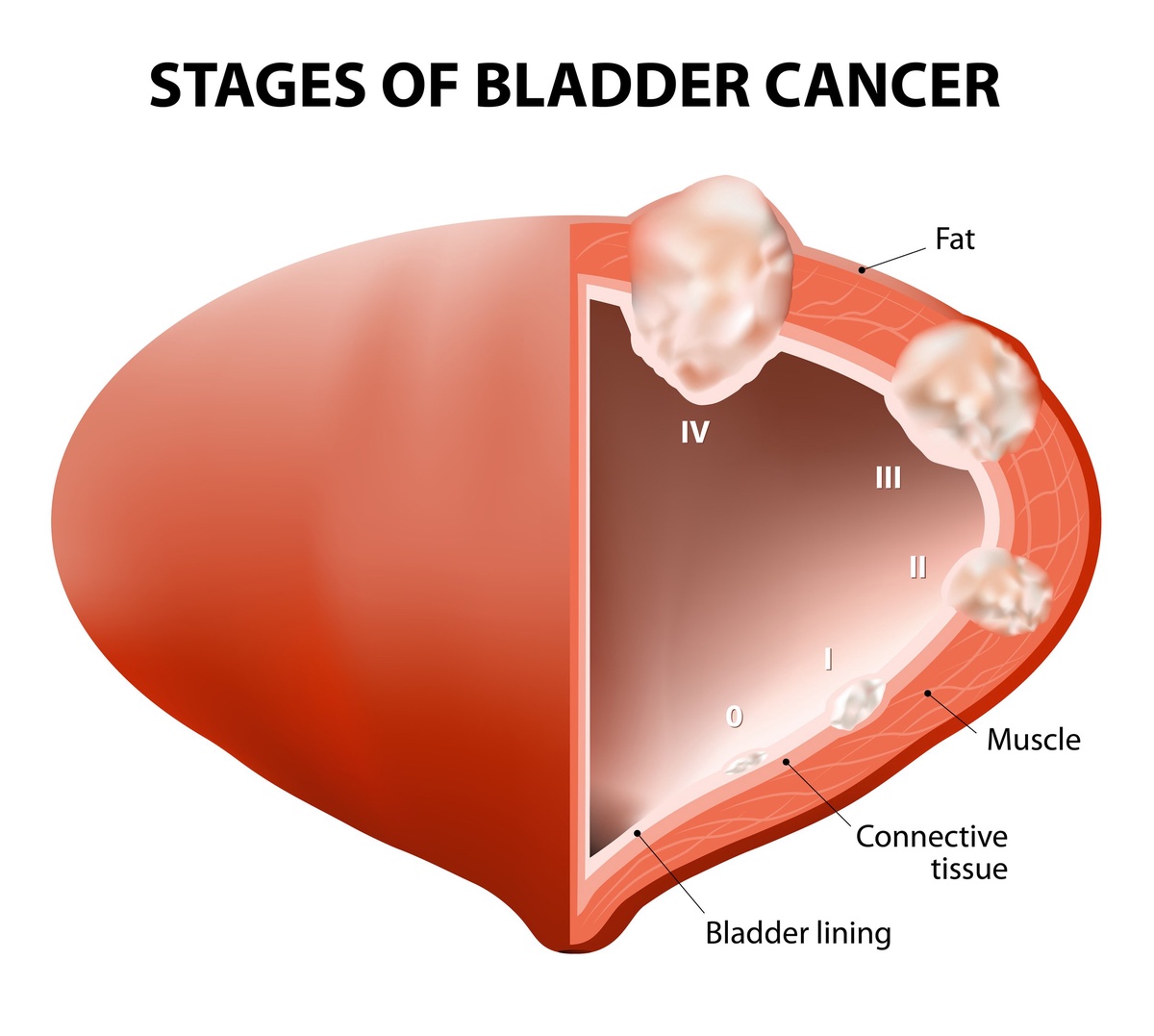 Receive Up-to-date and Effective Treatment from Renowned Bladder Cancer Specialist in Melbourne