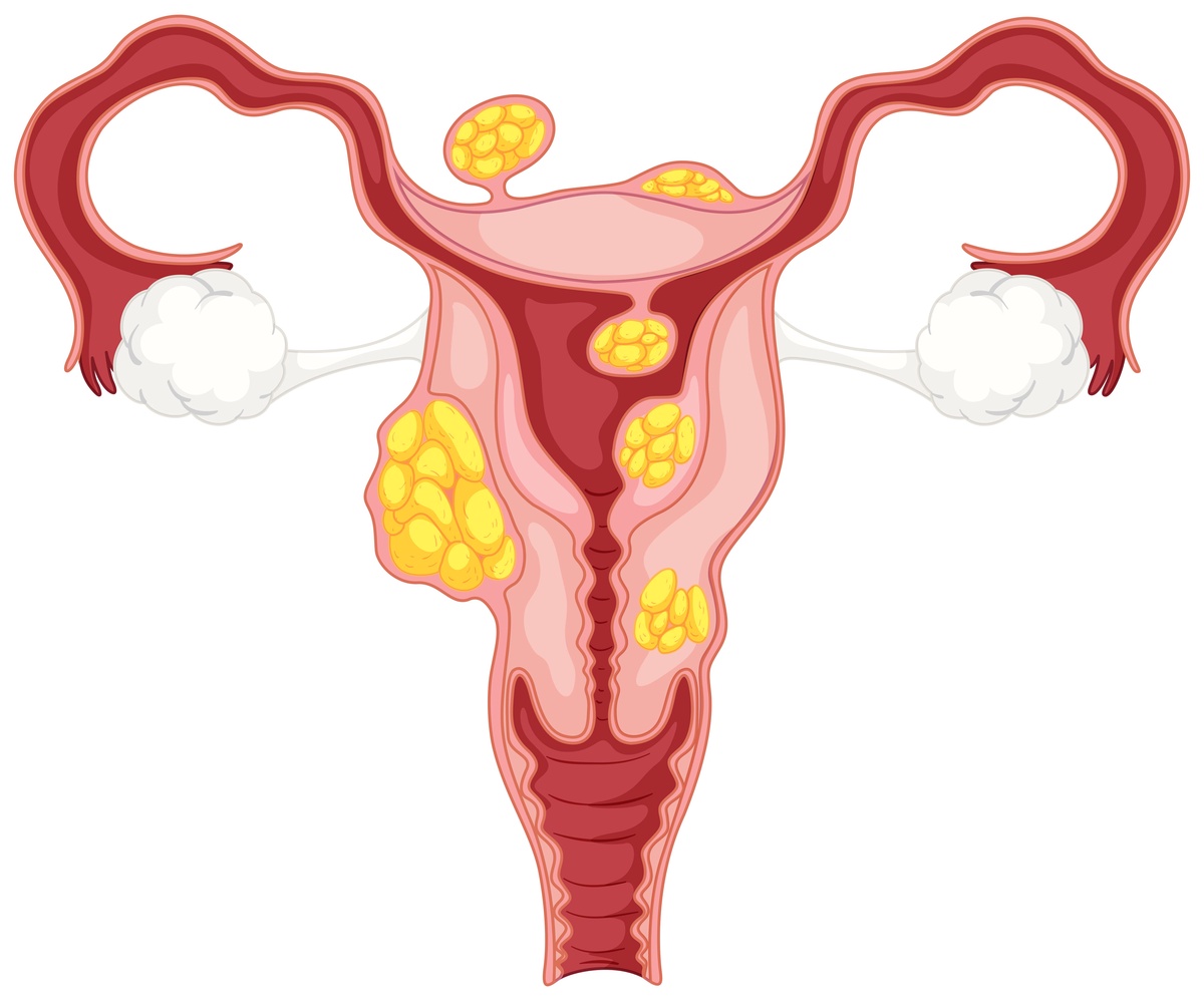 What Is Bulky Uterus? Causes, Symptoms, Treatment