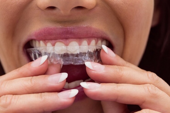The Comprehensive Guide to Birmingham Dental Implants