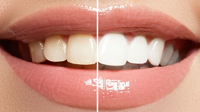 Brighten Your Smile: Benefits of Professional Teeth Whitening