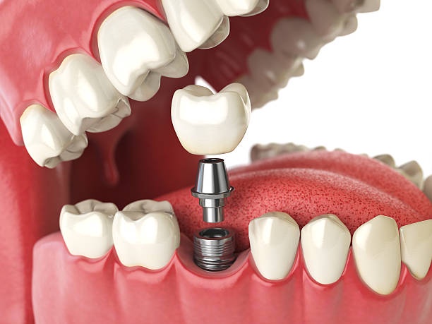 Affordable Options: Dental Implant Cost Abu Dhabi