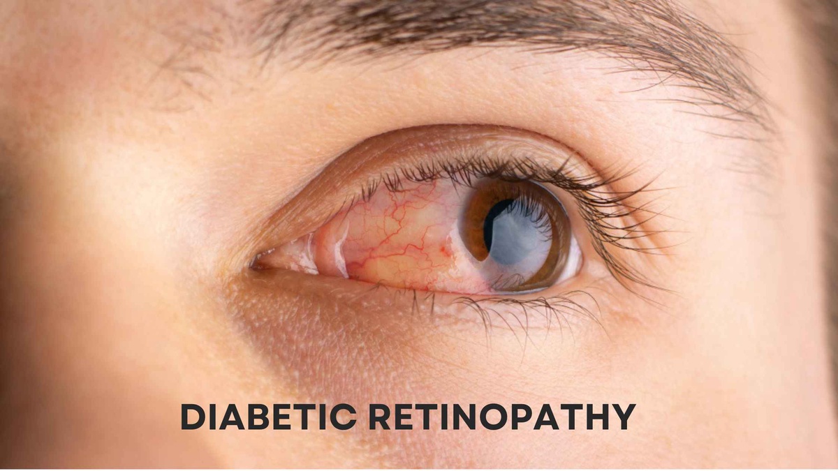 Diabetic Retinopathy: Safeguard Your Vision with Advanced Therapies