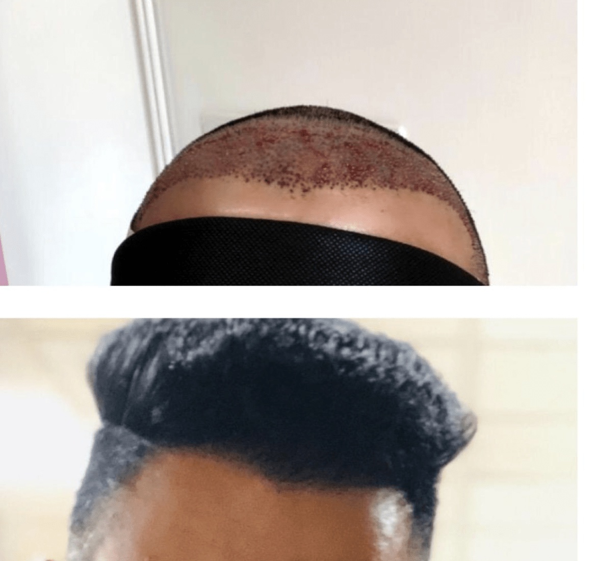 Unlocking Confidence: Exploring the Real hair transplant UK cost