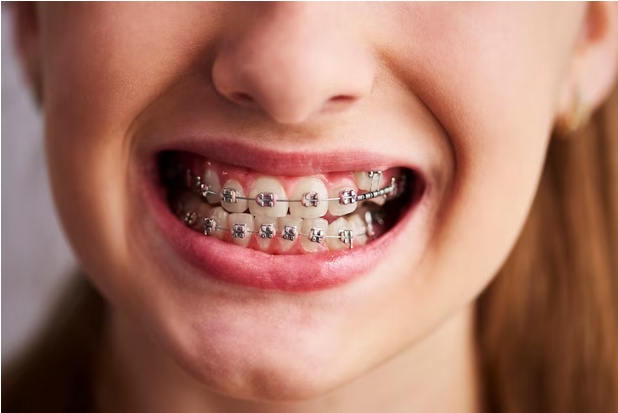 Navigating Orthodontic Bliss: Essex's Top Braces Trends Unveiled