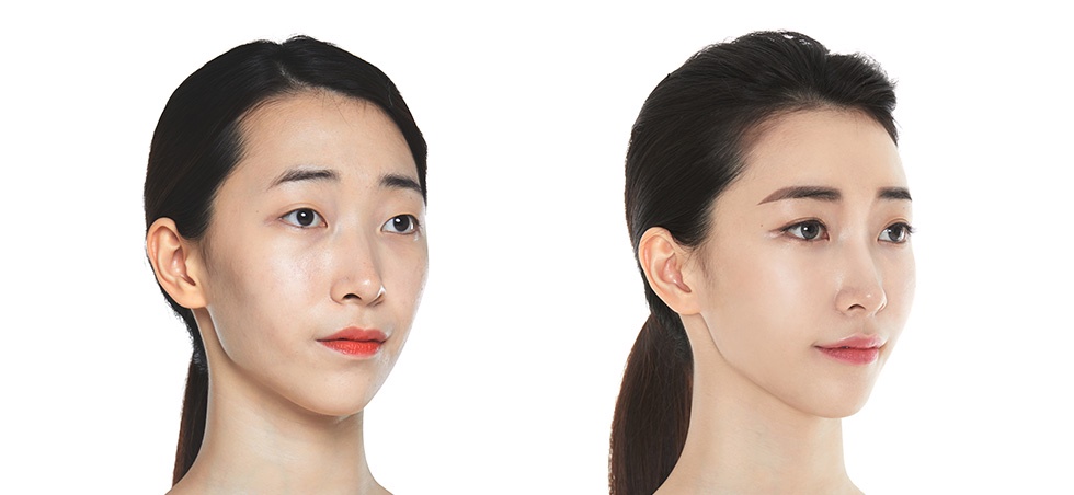 Demystifying Korean Face Surgery Recovery: A Patient-Centered Guide