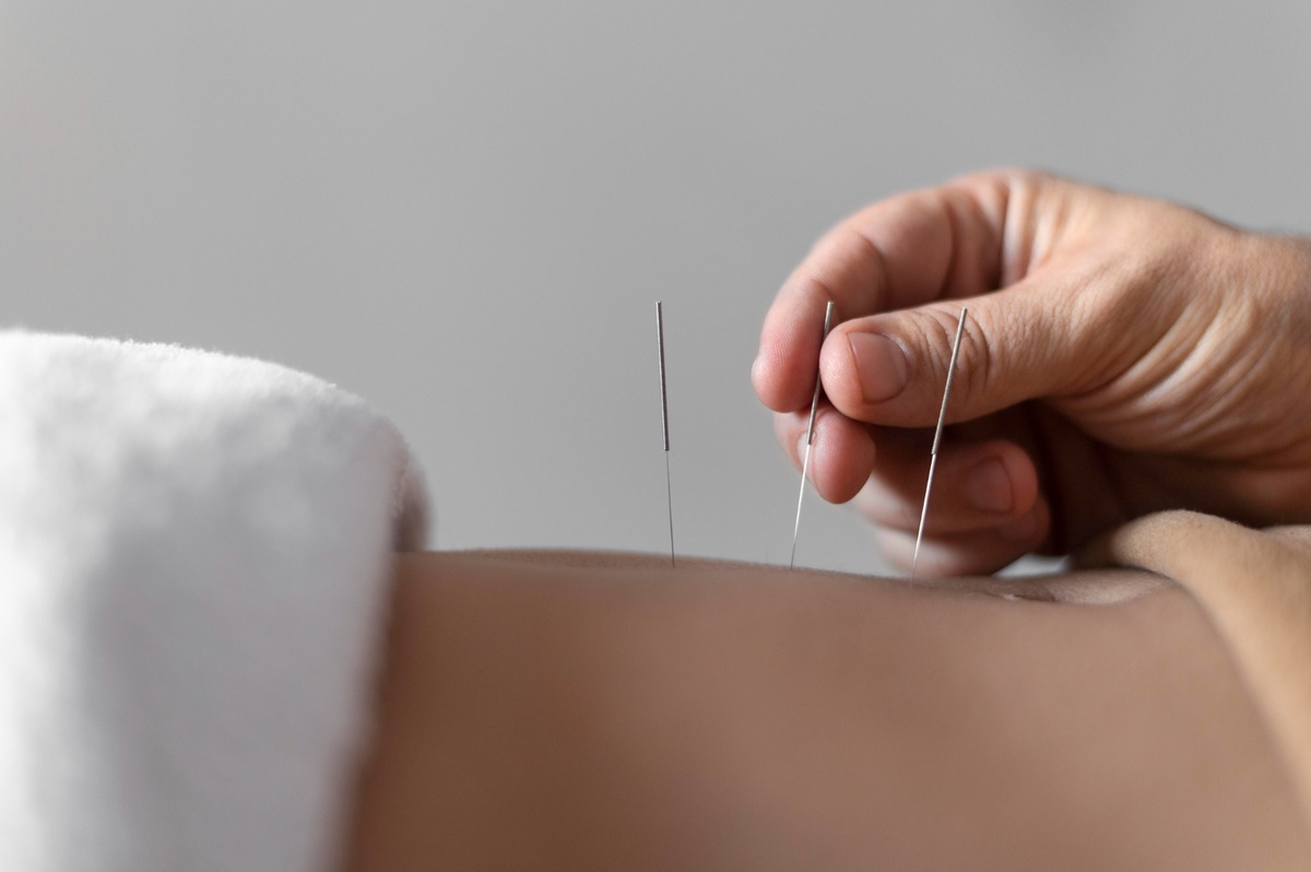 The Essential Guide to Acupuncture Billing Services