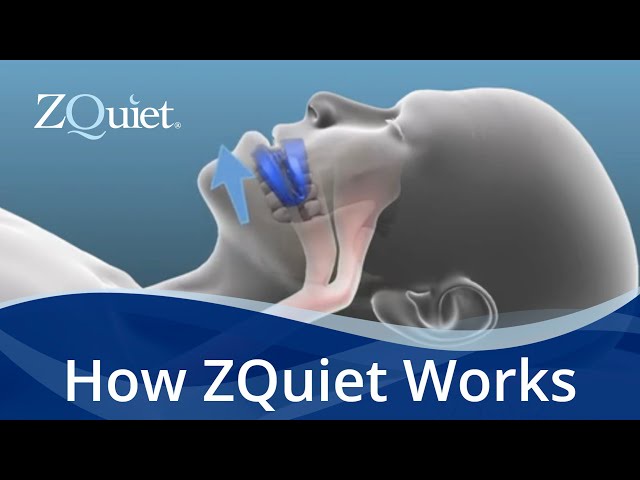 Silent Nights Await: The Power of ZQuiet Mouthpiece in Banishing Snores