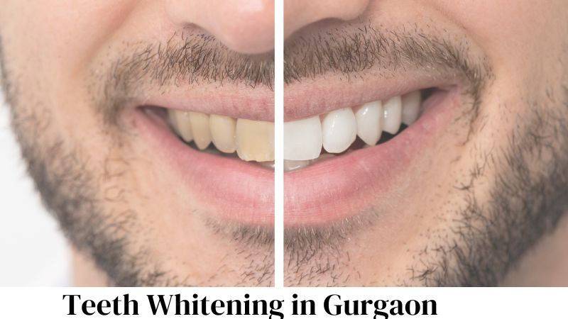 Say Goodbye to Stained Teeth: Dr. Ishant Singhal's Guide to Effective Teeth Whitening