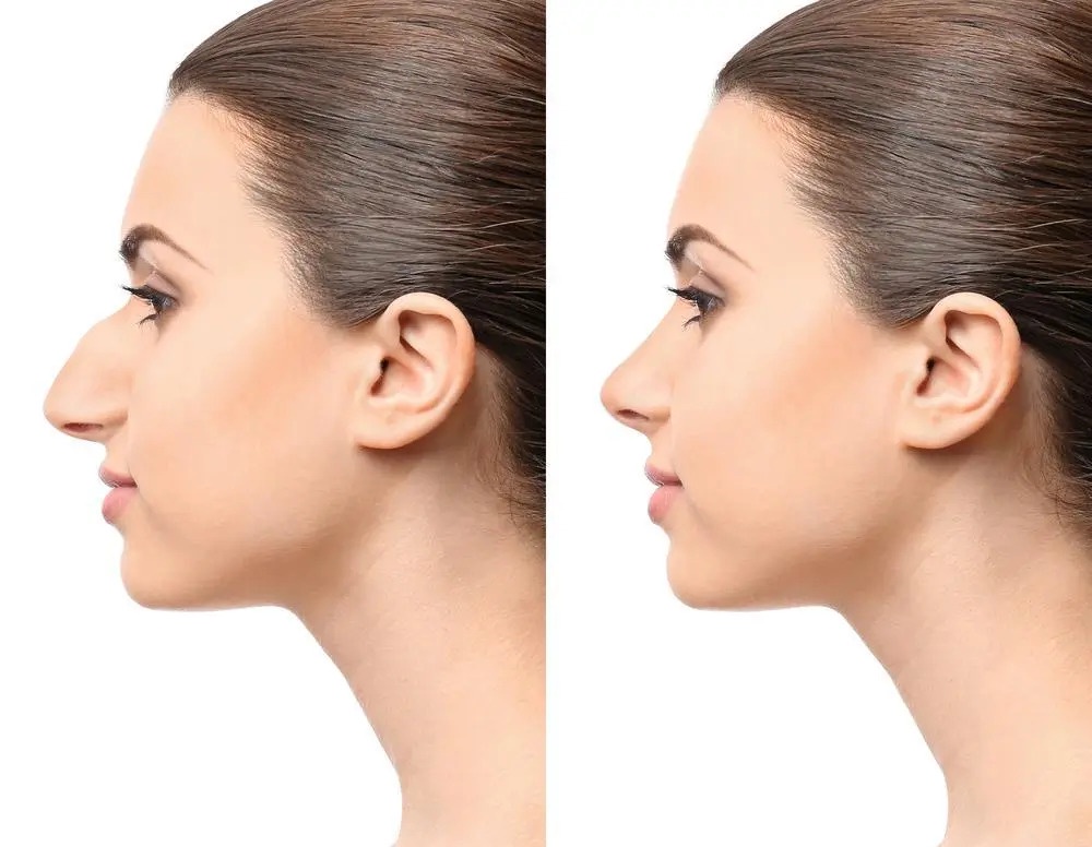 Broad Nose Correction With Rhinoplasty