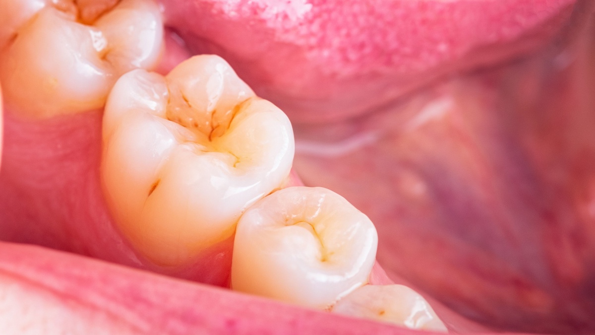 Decoding Dental Health: What Do Cavities Look Like?