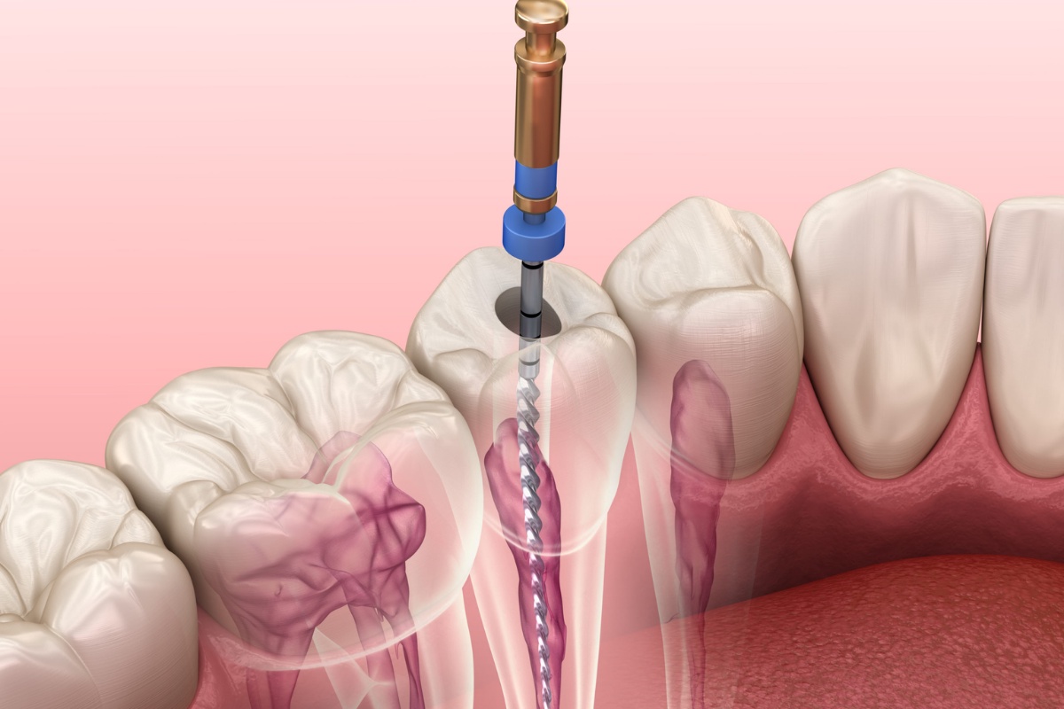 Exploring Root Canal Solutions And Its Costs In Toronto