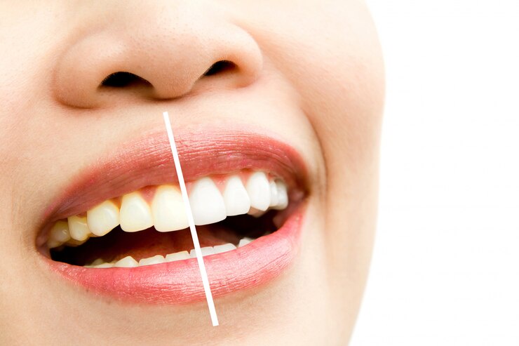 Brighten Your Smile: Discover Teeth Whitening Options in Plymouth
