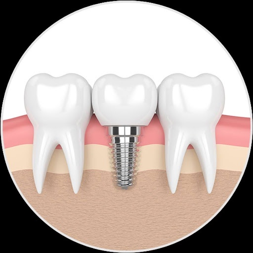 Your Guide to Dental Implants in Watertown, SD