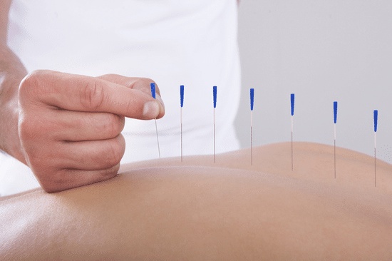 How Can Dry Needling Therapy in Edmonton Improve Your Well-being?