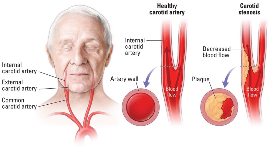 The Connection between Carotid Artery Disease and Peripheral Artery Disease