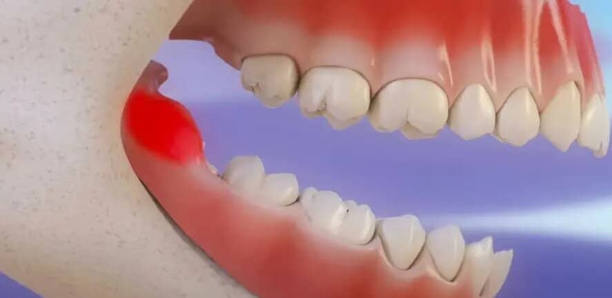 Understanding Wisdom Tooth Removal in Singapore