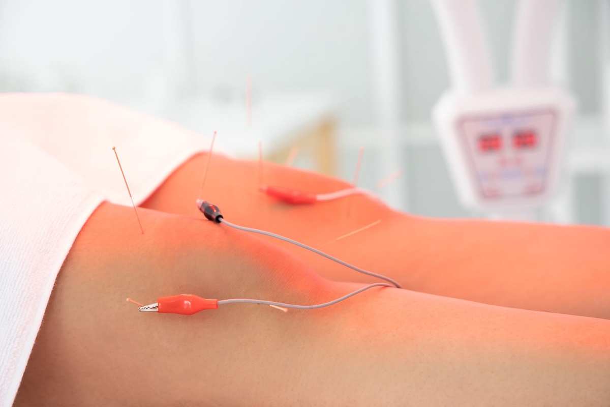 Exploring Electro-Acupuncture: Unlocking its Benefits for Well-Being