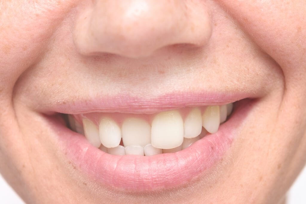Understanding Protruding Teeth: Causes, Symptoms, and Treatment Options