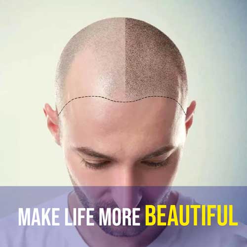 The Quest for the Best Hair Transplant in Bangalore